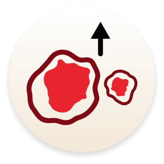 An illustration of blood cells to visualize higher percentage of blasts associated with higher grades of bone marrow fibrosis